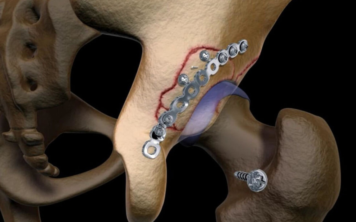 Pelvic Acetabulum Fracture Surgery in Ahmedabad, Gujarat